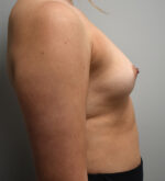 Breast Augmentation