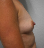 Breast Augmentation