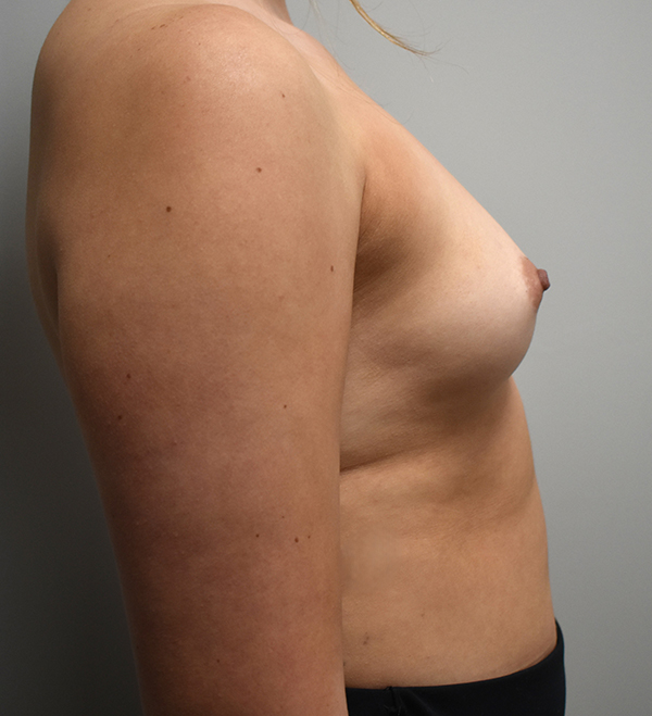 Breast Augmentation