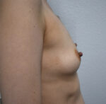 Breast Reconstruction