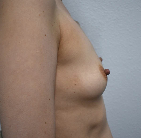 Breast Reconstruction