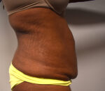 Tummy Tuck