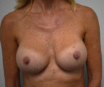 Breast Implant Exchange