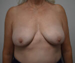 Breast Implant Exchange