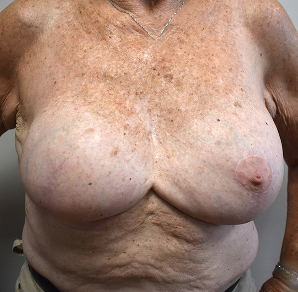 front-view-after-breast-reconstruction Breast Reconstruction