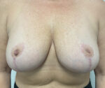 Implant Removal