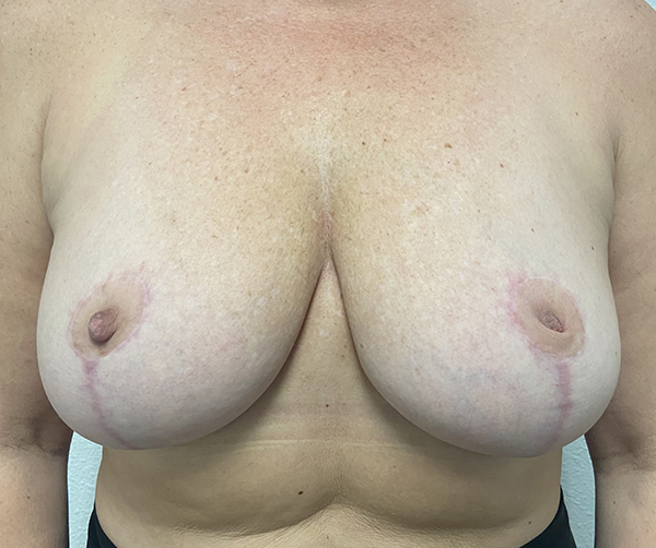 front-view-after-implant-removal-mastopexy Implant Removal