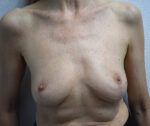 Implant Removal