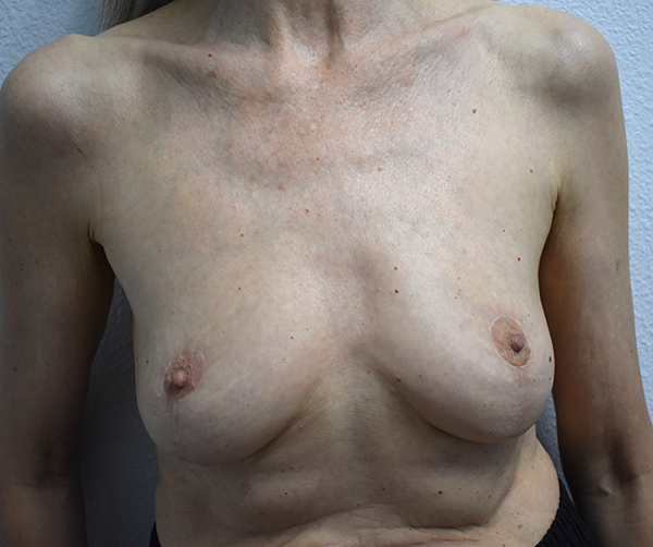 front-view-after-implant-removal-mastopexy Implant Removal