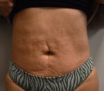Liposuction