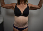 Weight Loss