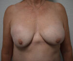 Breast Implant Exchange