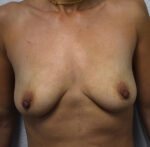 Breast Reconstruction