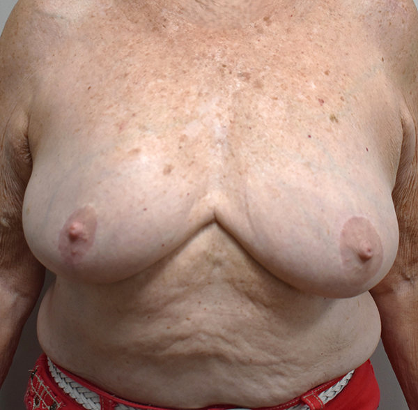 front-view-before-breast-reconstruction Breast Reconstruction