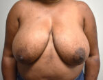 Breast Reduction