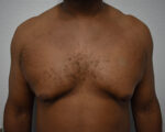Gynecomastia