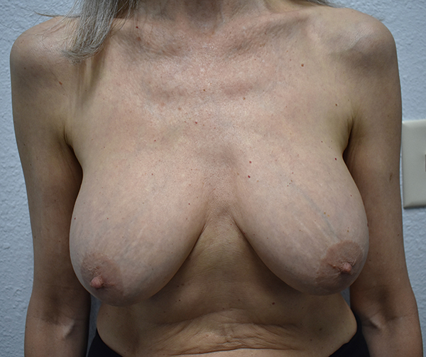front-view-before-implant-removal-mastopexy Implant Removal