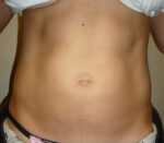 Liposuction
