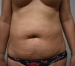 Liposuction