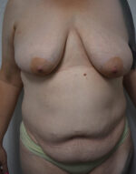 Mommy Makeover