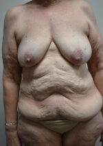 Weight Loss