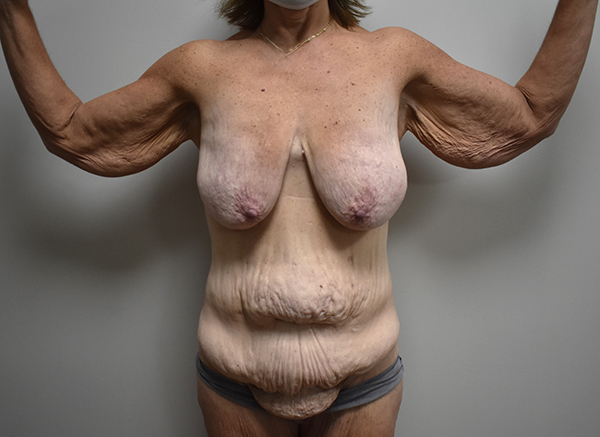 front-view-before-weight loss Weight Loss