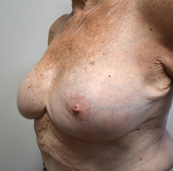 Breast Reconstruction