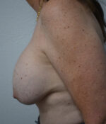 Implant Removal