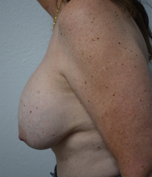 Implant Removal