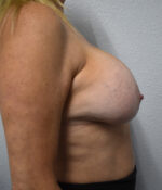 Implant Removal