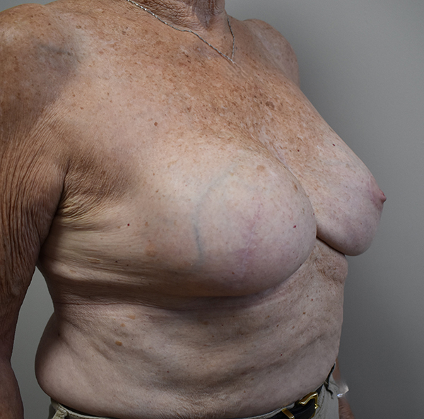 Breast Reconstruction
