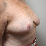 Breast Reconstruction