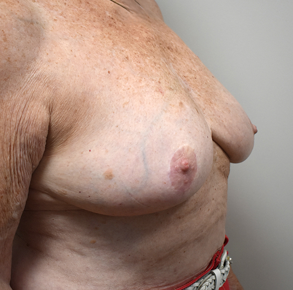 Breast Reconstruction