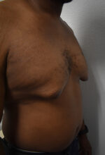 Gynecomastia