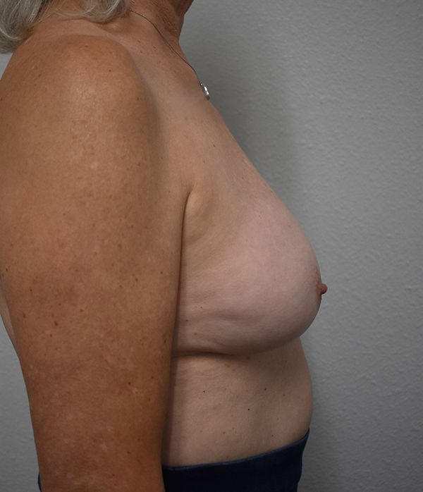 Breast Implant Exchange