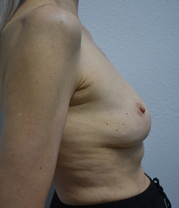 Implant Removal