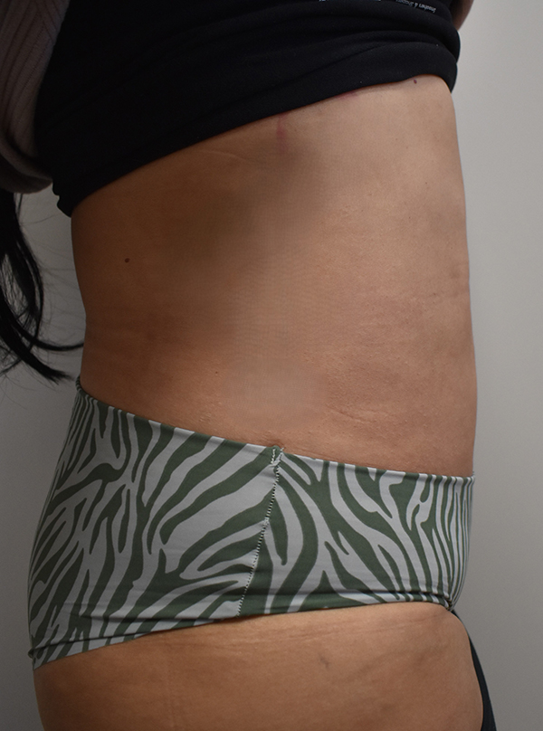 right-side-view-after-liposuction Liposuction