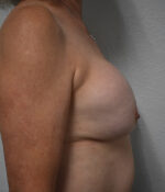 Breast Implant Exchange