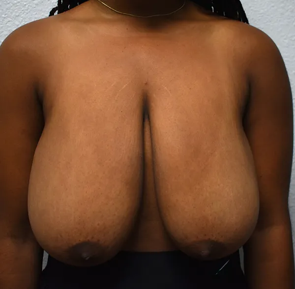 Breast Reduction