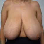 Breast Reduction