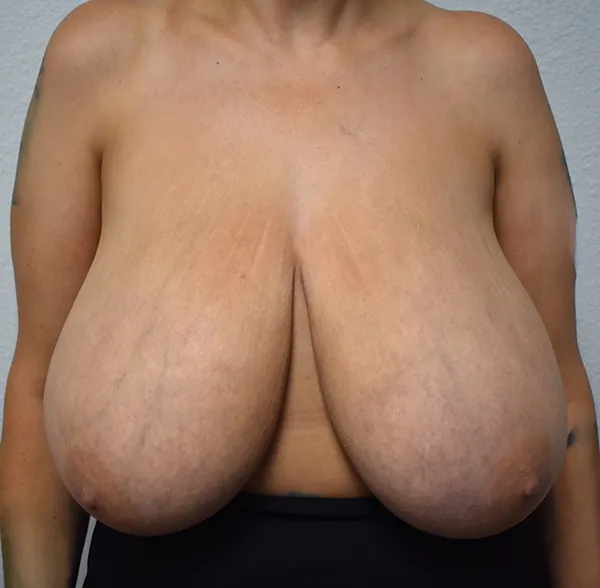 Breast Reduction