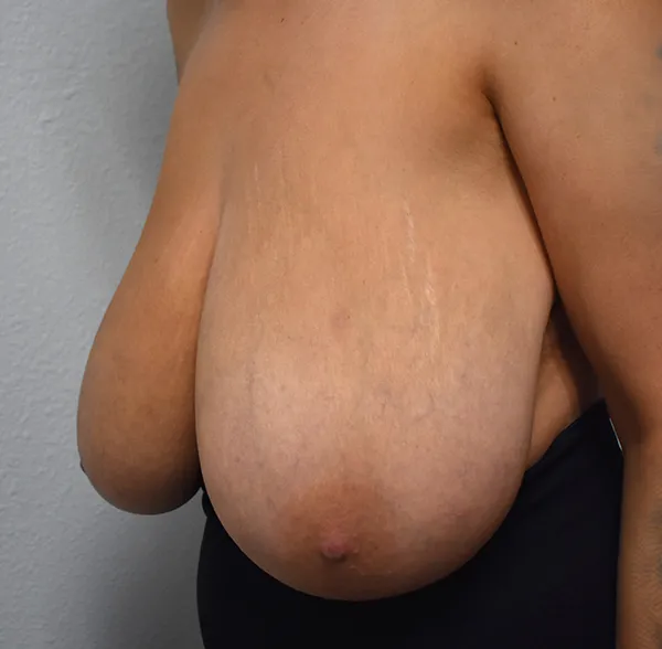Breast Reduction