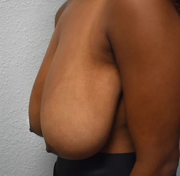 Breast Reduction
