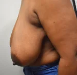 Breast Reduction