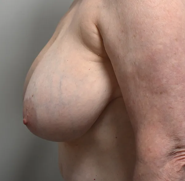 Breast Reduction
