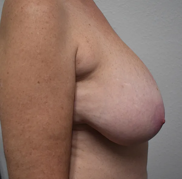 Breast Reduction