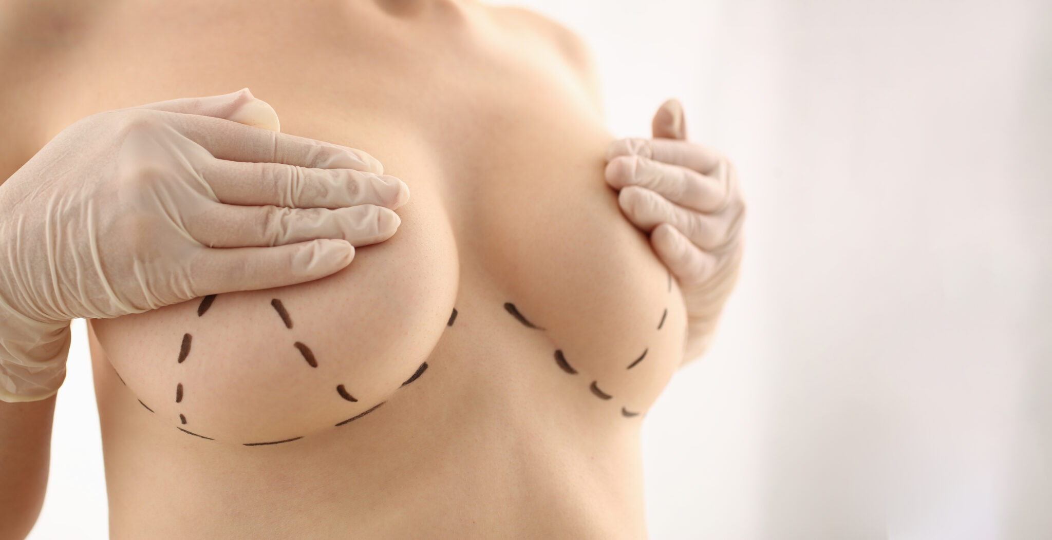 Breast Lift Myths