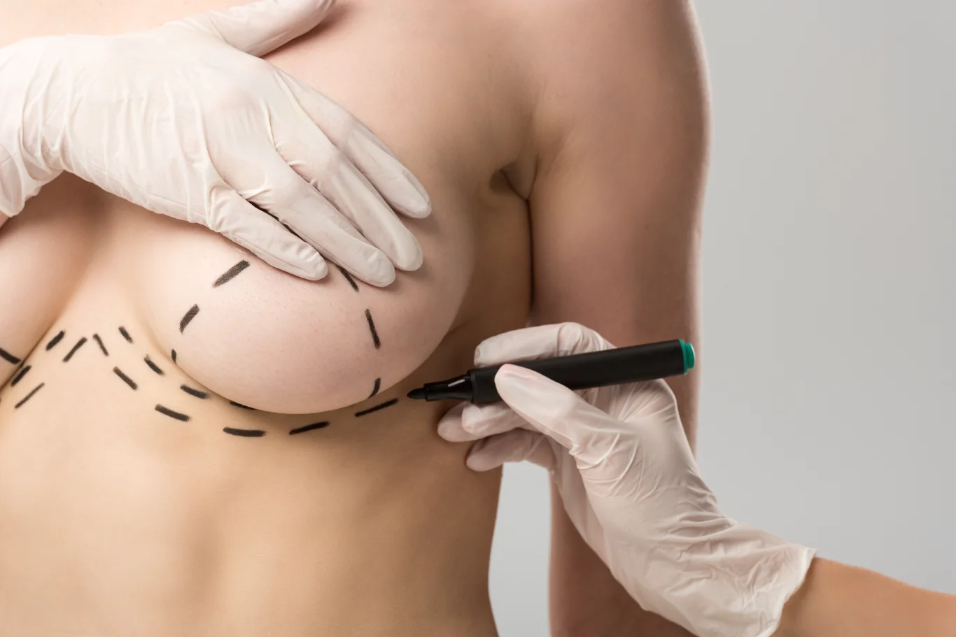 A close-up of a plastic surgeon wearing white medical gloves using a black surgical marker to draw precise guide lines