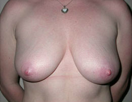 Breast Lift Surgery