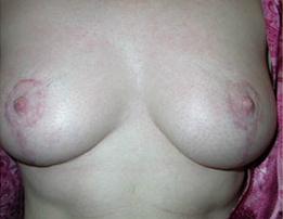 Breast Enhancement